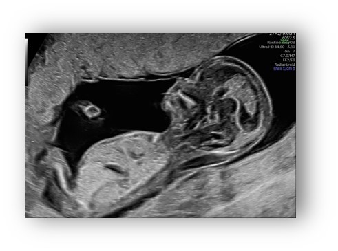 voluson expert gal 1