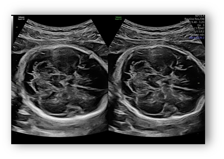 voluson expert gal 11