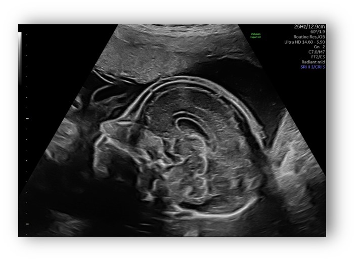 voluson expert gal 12