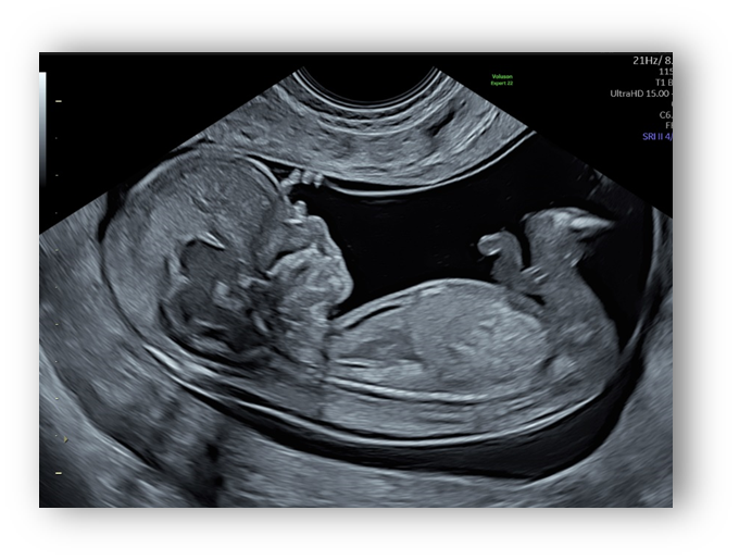 voluson expert gal 13