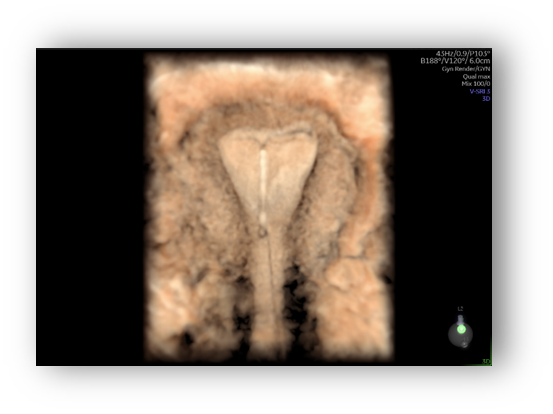 voluson expert gal 14