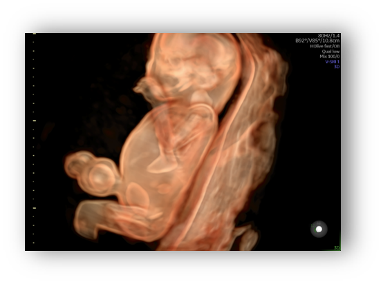 voluson expert gal 15