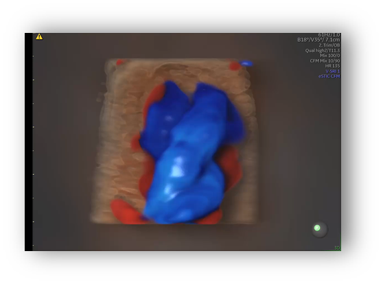 voluson expert gal 17