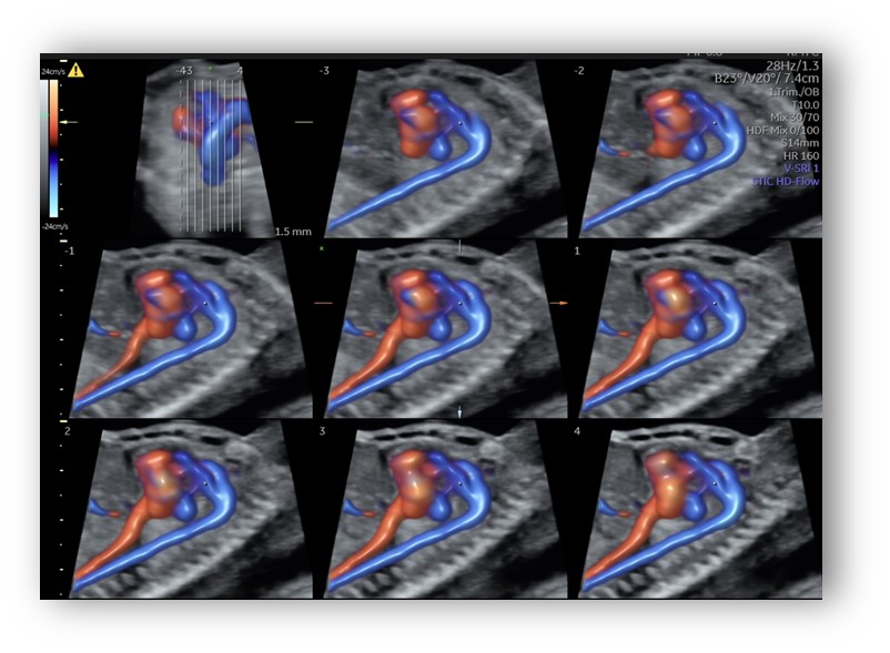 voluson expert gal 18