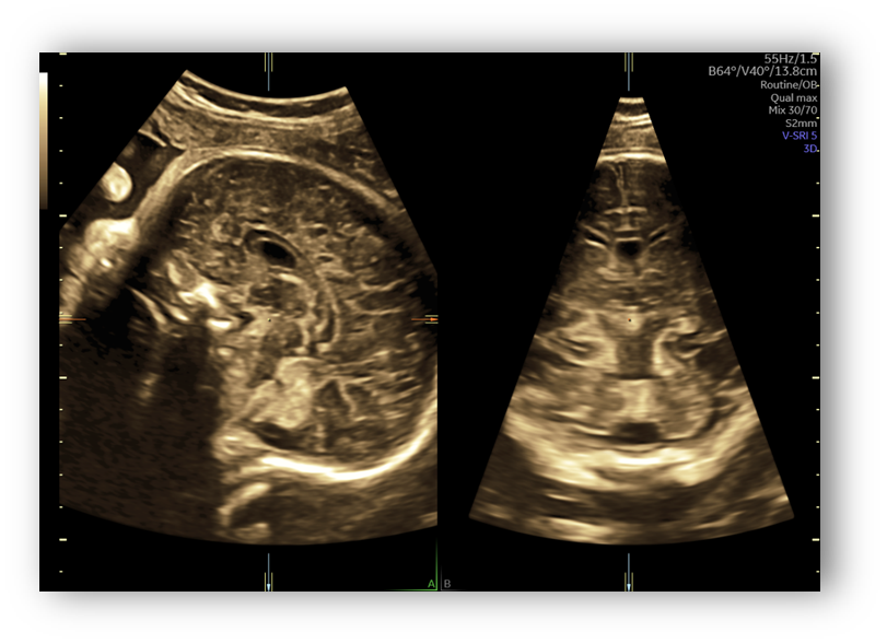 voluson expert gal 19