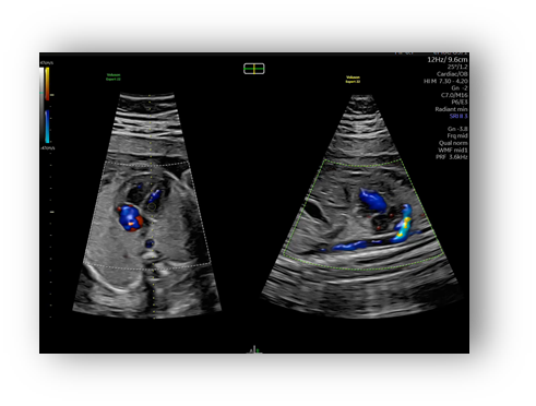 voluson expert gal 2