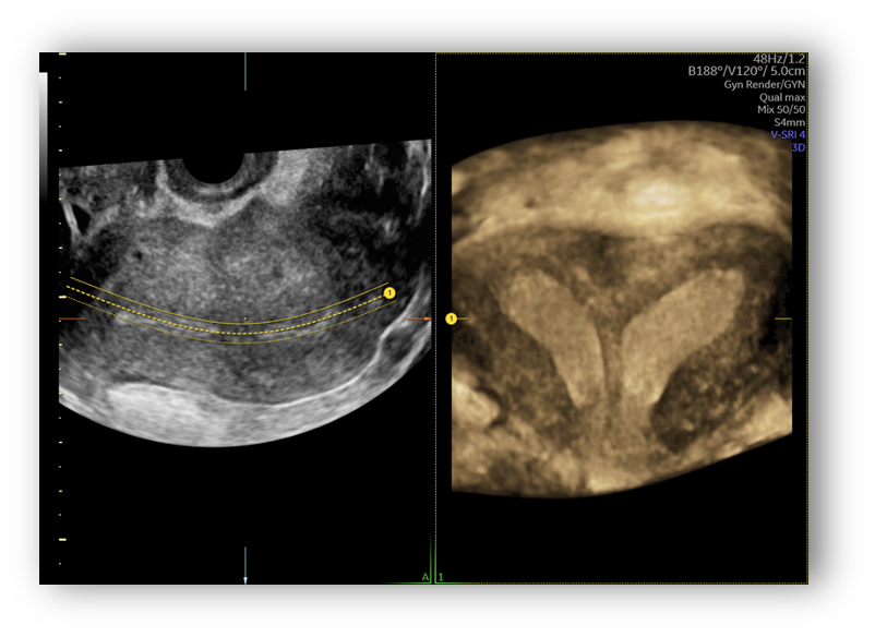 voluson expert gal 21