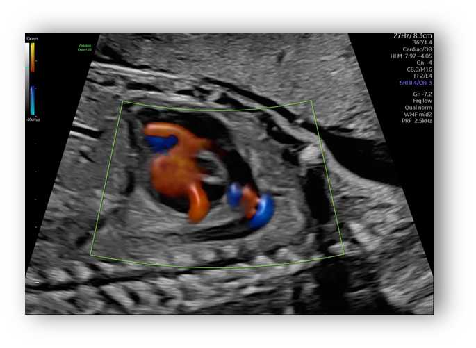 voluson expert gal 22