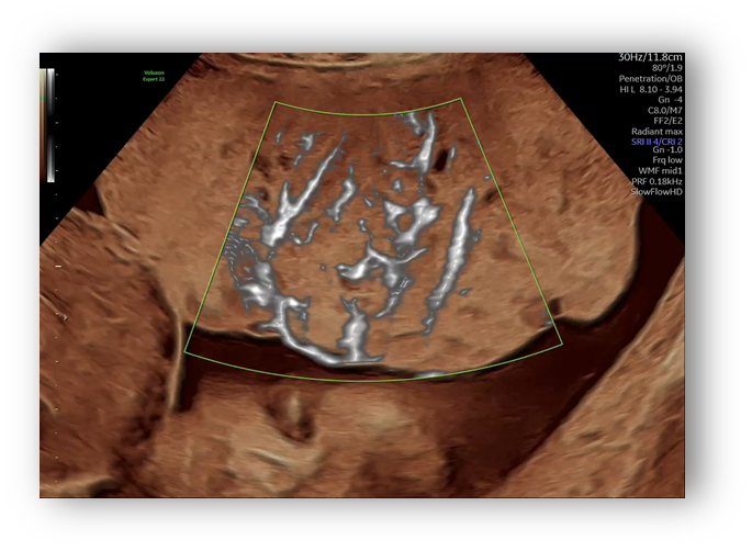 voluson expert gal 23