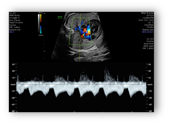 voluson expert gal 24