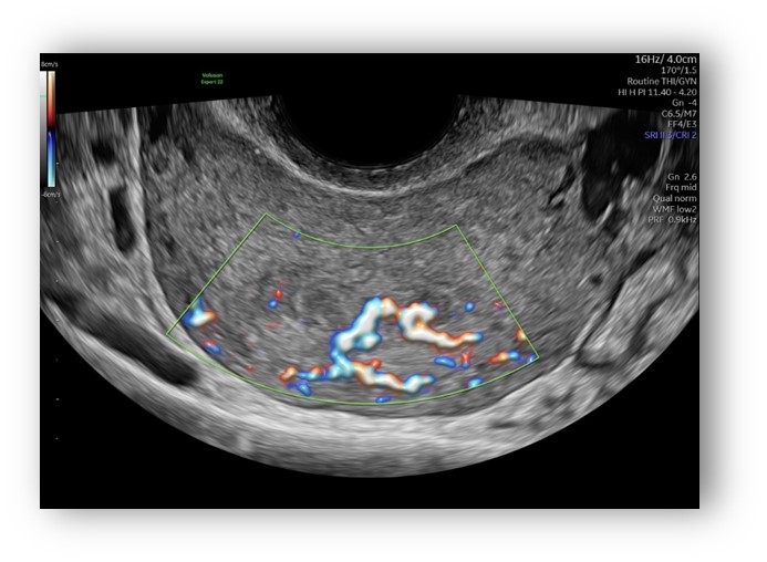 voluson expert gal 27