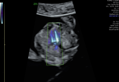 voluson expert gal 29