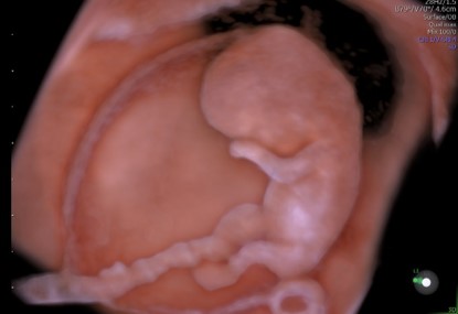 voluson expert gal 30