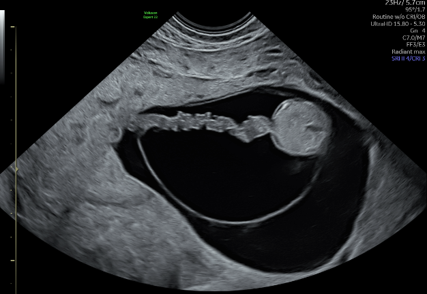 voluson expert gal 31