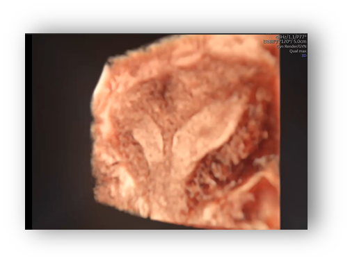 voluson expert gal 4