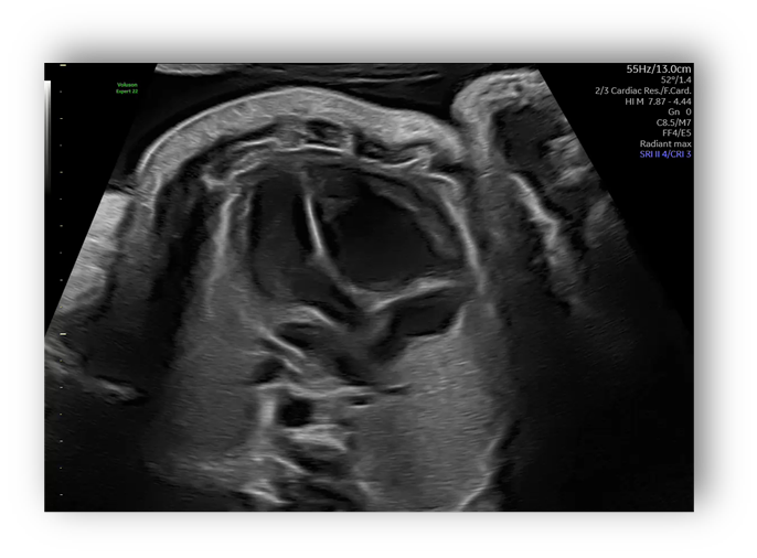 voluson expert gal 9