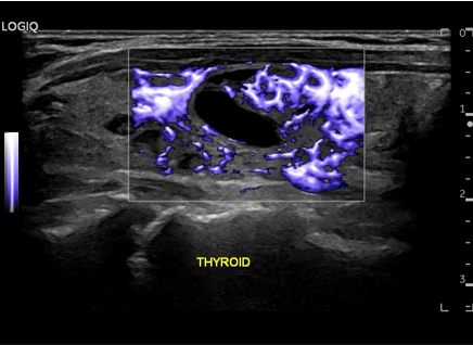 Logiq fortis Imagen2