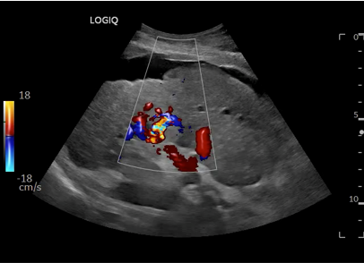 Logiq fortis Imagen3