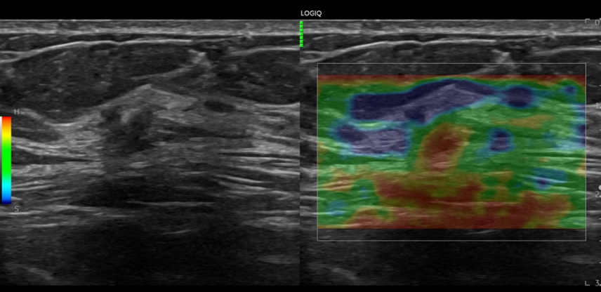 Logiq fortis Imagen6