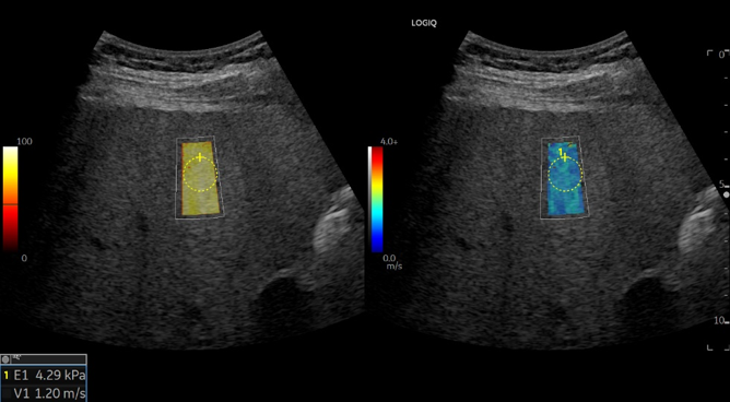 Logiq fortis Imagen7