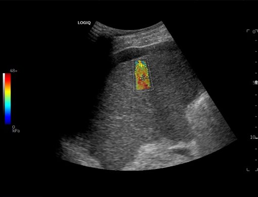 Logiq fortis Imagen8