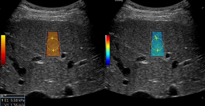 Logiq fortis Imagen9