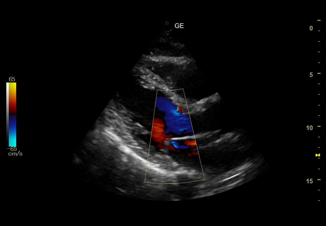 VB2 CARDIAC PLAX COLOR MR