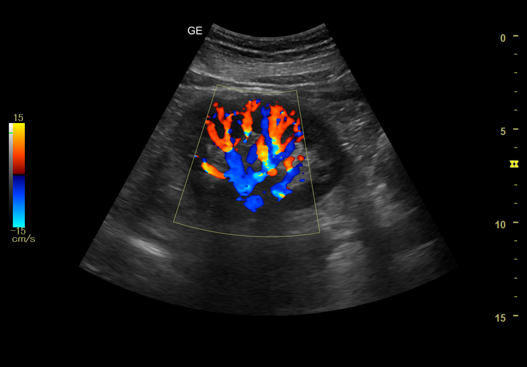 VB2 abdomen renal with color